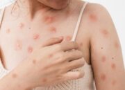 Cacar Monyet Mudah Menular, Warga Padang Diimbau Terapkan PHBS dan Germas