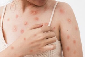 Cacar Monyet Mudah Menular, Warga Padang Diimbau Terapkan PHBS dan Germas